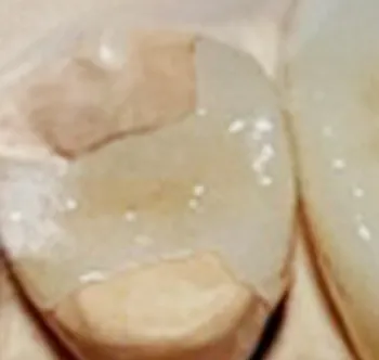 深い虫歯の被せ物ハイブリットセラミック冠