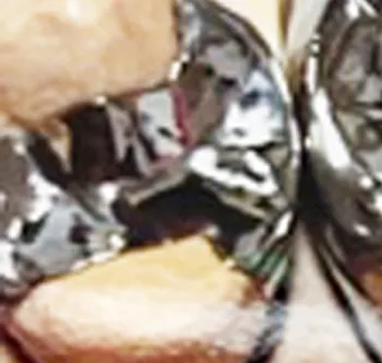 深い虫歯の被せ物銀パラジウム冠