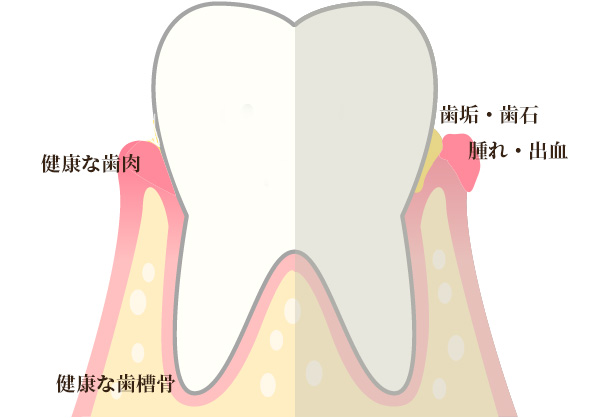 歯周病の種類
