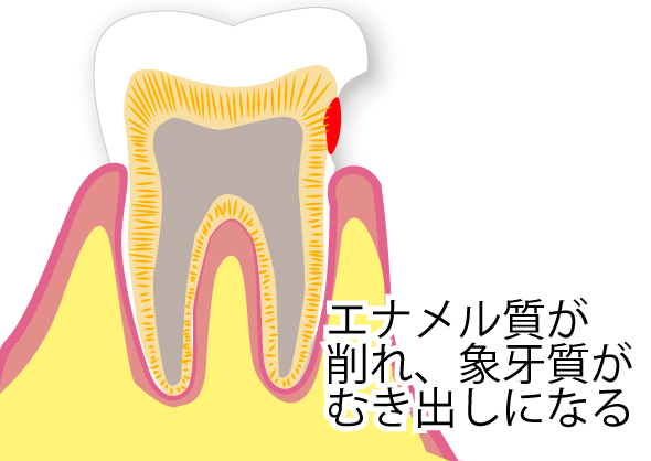 知覚過敏になるとなんで痛いのか？原因とは
