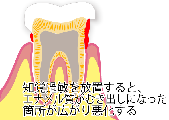 知覚過敏を放置するとどうなる？