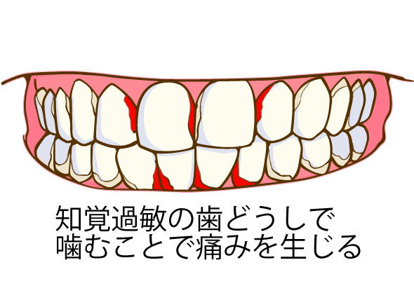 噛む力の低下