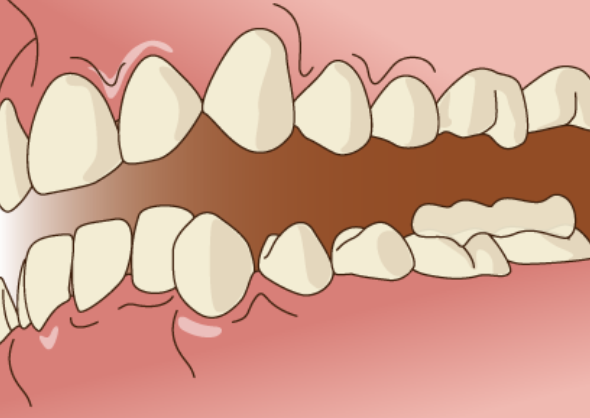 歯科矯正でかみ合わせが悪くなる？