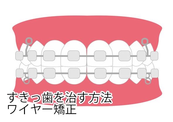 ワイヤー矯正