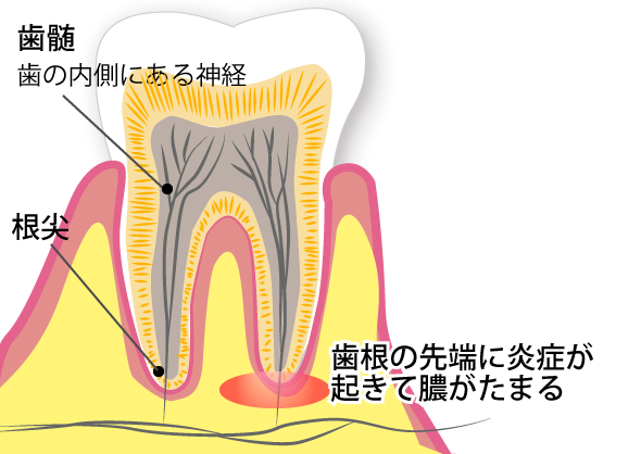 根に膿が溜まっている（根尖性歯周炎）