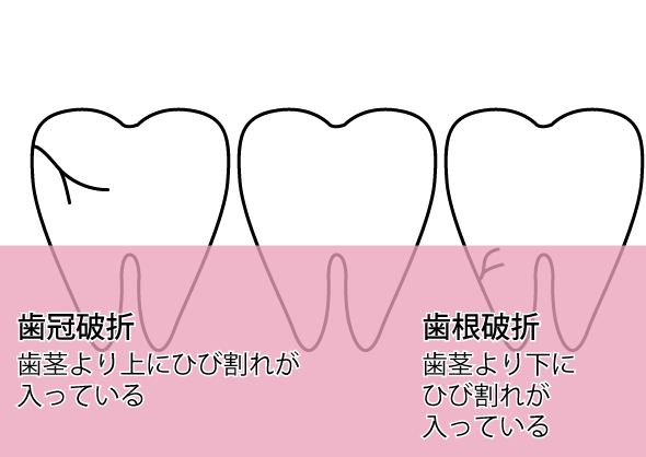 根尖性歯周炎の治療