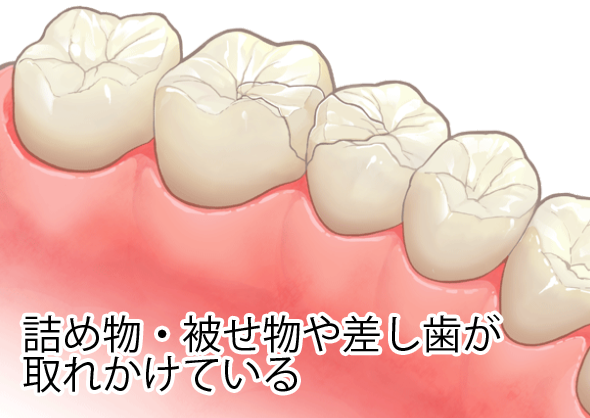 詰め物・被せ物や差し歯が取れかけている