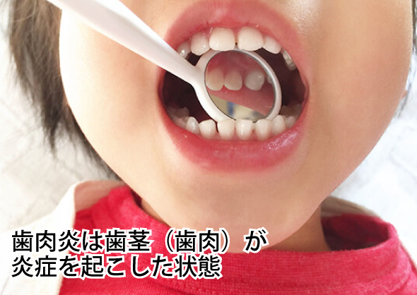 歯肉炎とは