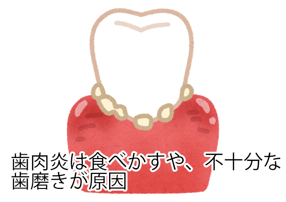 歯肉炎の症状