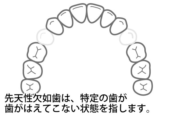 先天性欠如歯