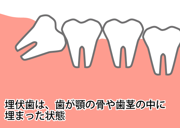 埋伏歯
