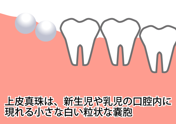 上皮真珠(じょうひしんじゅ)