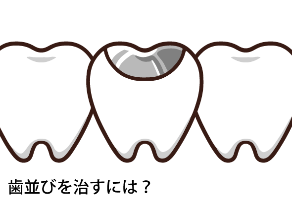 歯の詰め物とは？