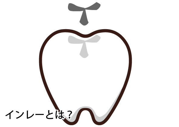 インレーとは？