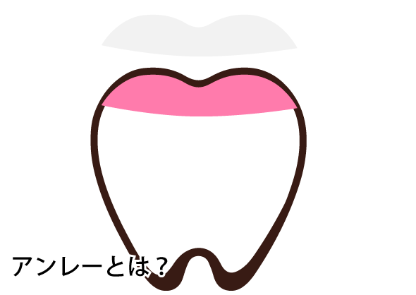 アンレーとは？