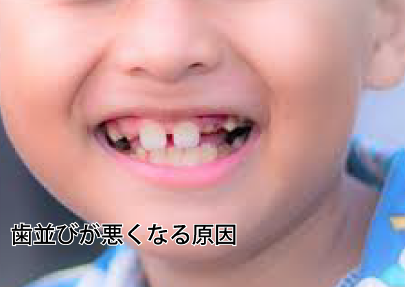 歯並びが悪くなる原因