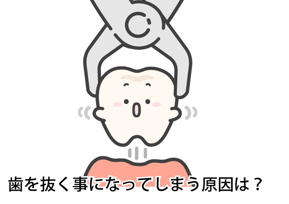 歯を抜く事になってしまう原因は？