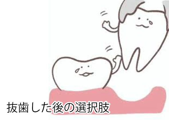 抜歯した後の選択肢