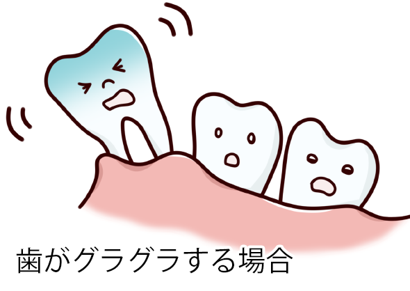 歯がグラグラする場合