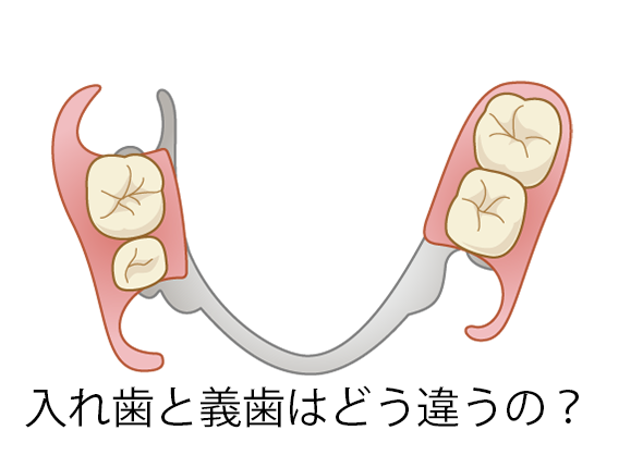 入れ歯と義歯はどう違うの？