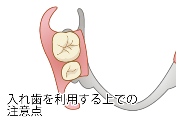 入れ歯を利用する上での注意点