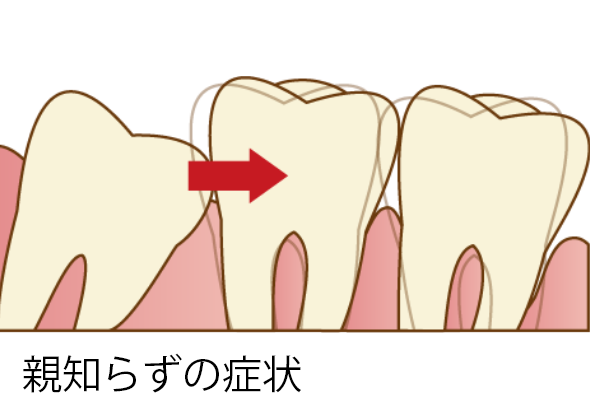 親知らずの症状