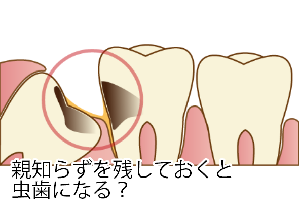 親知らずを残しておくと虫歯になる?