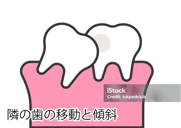 隣の歯の移動と傾斜
