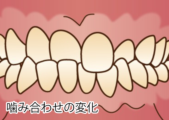 噛み合わせの変化