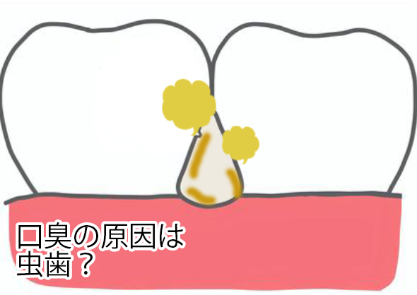 口臭の原因は虫歯？