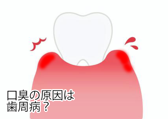 口臭の原因は歯周病？