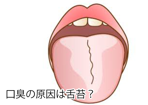 口臭の原因は舌苔（ぜったい）？
