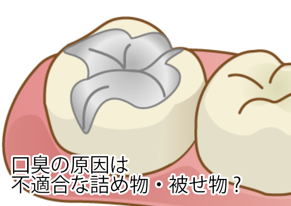口臭の原因は不適合な詰め物・被せ物？
