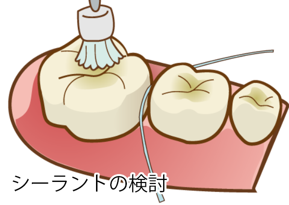 シーラントの検討