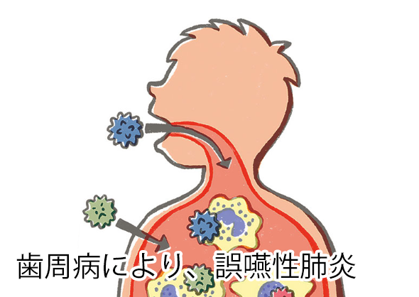 歯周病により誤嚥性肺炎