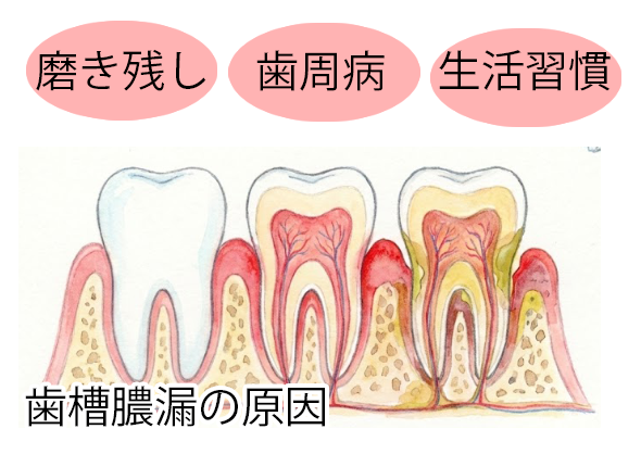 歯槽膿漏の原因
