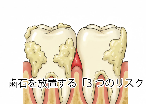 歯石の正体と「負のサイクル」