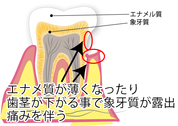 知覚過敏：歯の中の「小さな運河」が騒ぎ出す