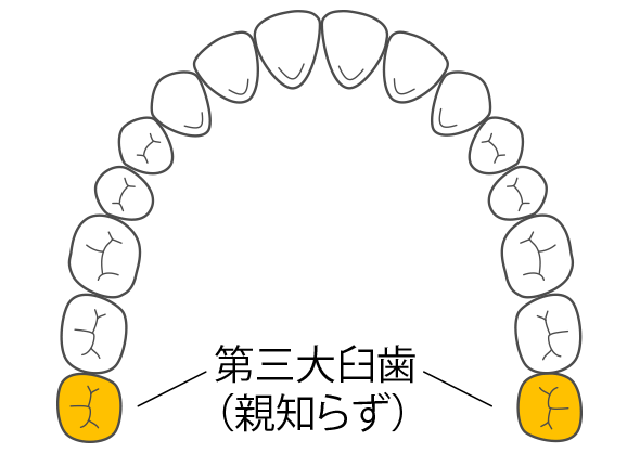 出っ歯（上顎前突）とは