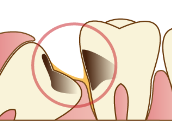 親知らずが痛くなる原因