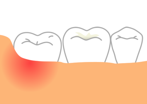 智歯周囲炎