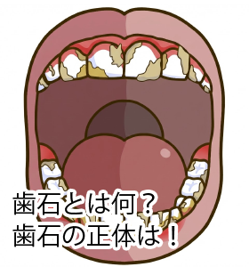 「歯石とは何？歯石の正体は！