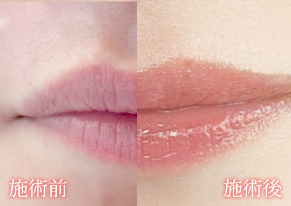 ぼやけた唇の色を整え、自然で整った顔立ちに近づけることが可能です