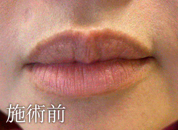 歯周病が原因で菌が入り込んで肺炎