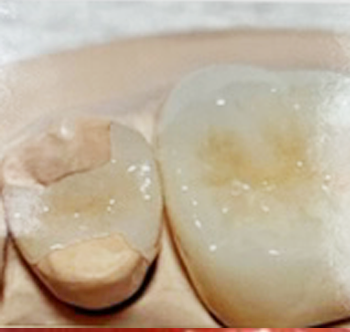 浅い虫歯の詰め物オールセラミック