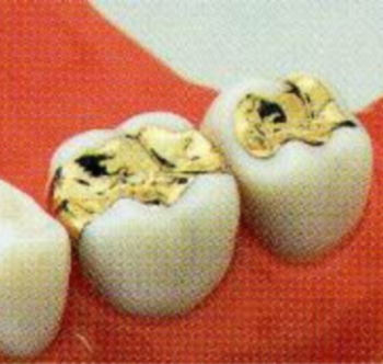 浅い虫歯の詰め物PGA