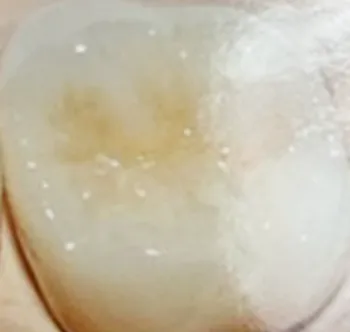 深い虫歯の被せ物セラミック冠